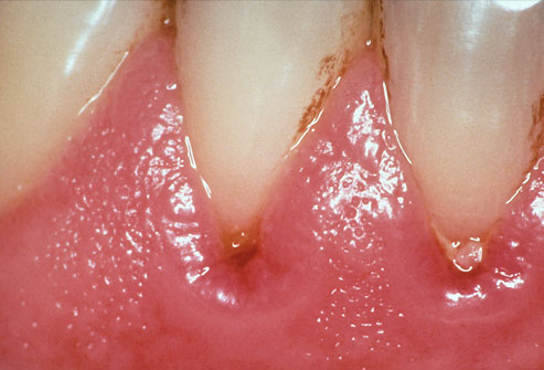 Bleeding Gums