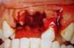 Dental Injury