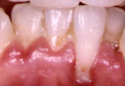 Gingivitis1