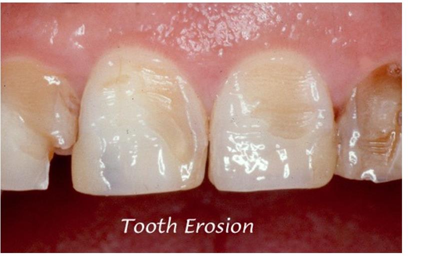 Tooth Erosion