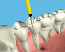 Root Canal