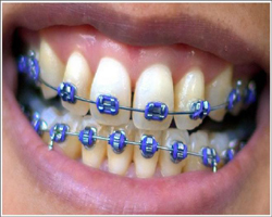 Braces Smile Purple