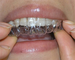 Invisalign