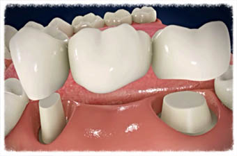 Dental Bridges