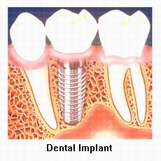 dental implant