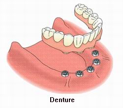 Full Denture