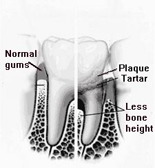 Periodontic Treatment