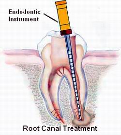 Root Canal Treatment