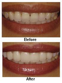 Tooth Veneers