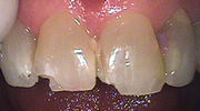 Broken or Chipped Tooth