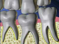Dental Ankylosis