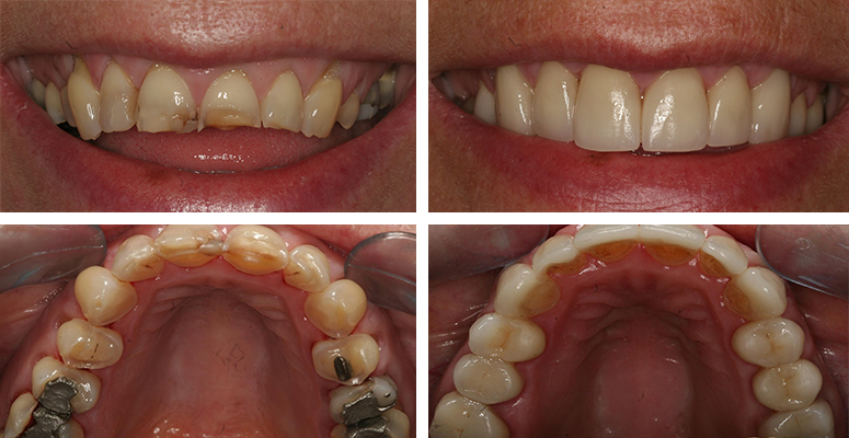 Tooth Abrasion