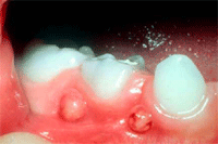 Tooth Abscess