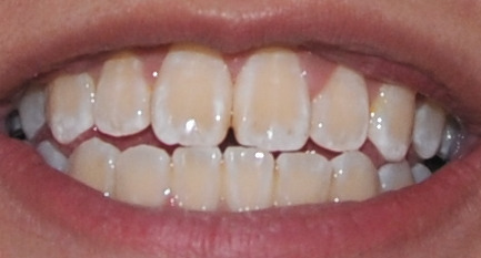 Tooth Discoloration